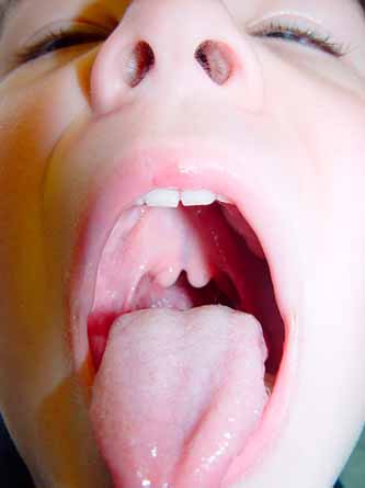 Submucous Cleft