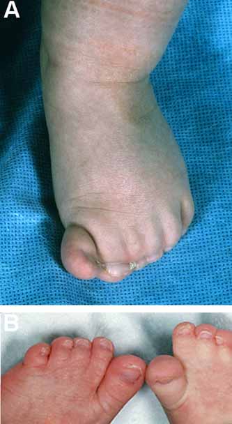 webbed toes human
