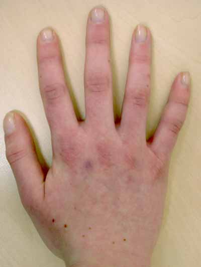 Clubbed fingers: MedlinePlus Medical Encyclopedia Image