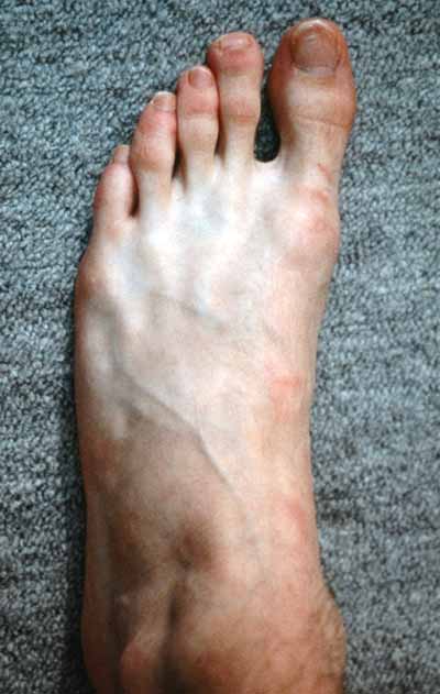 narrow feet